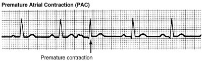 premature atrial contractions vs premature ventricular contractions