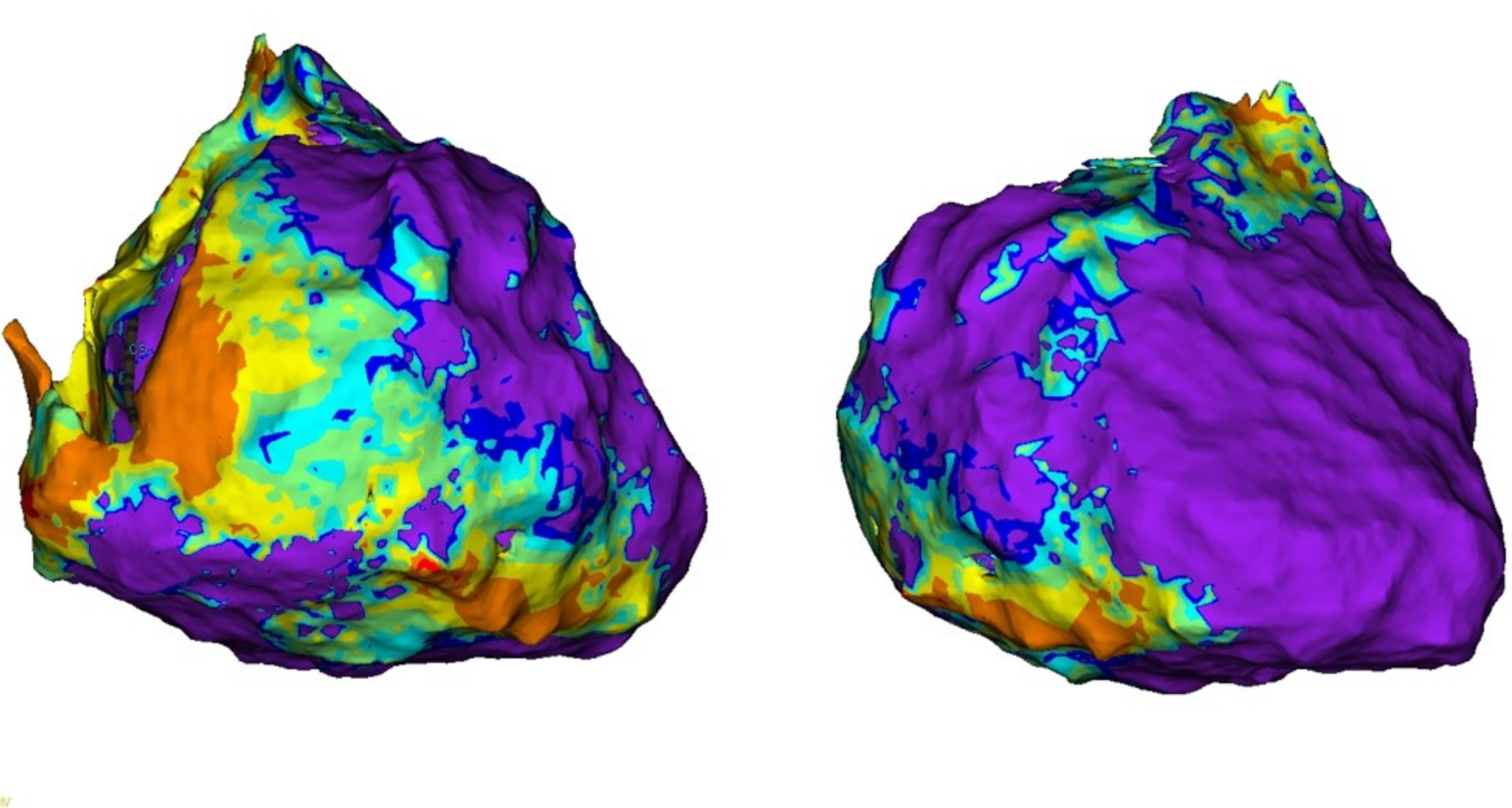 High-density three-dimensional mapping of the heart’s outer surface (epicardium). The orange and yellow areas indicate regions of scarring in the heart.