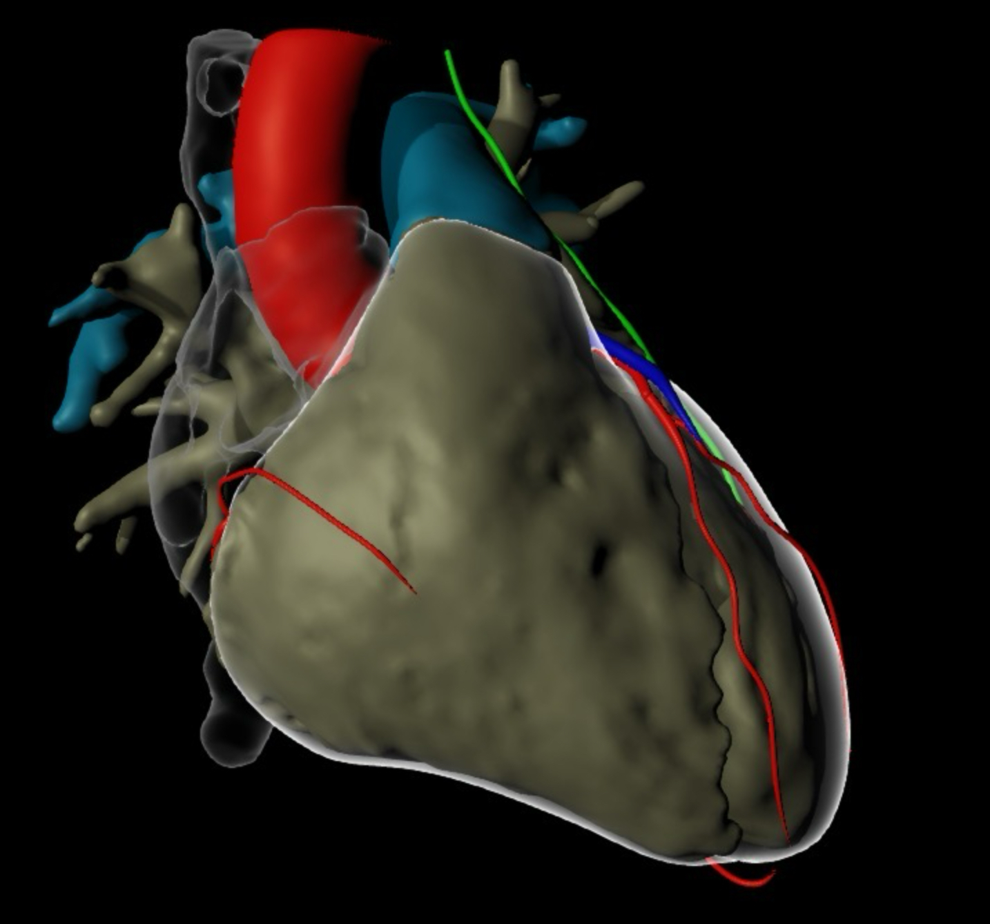 Advanced cardiac imaging – generated from a cardiac CT scan – is used to guide ventricular tachycardia ablation procedures.