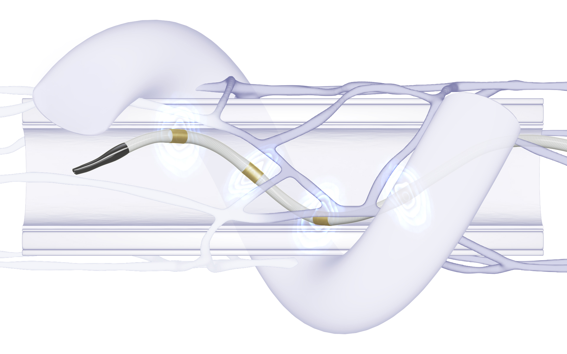 renal denervation procedure