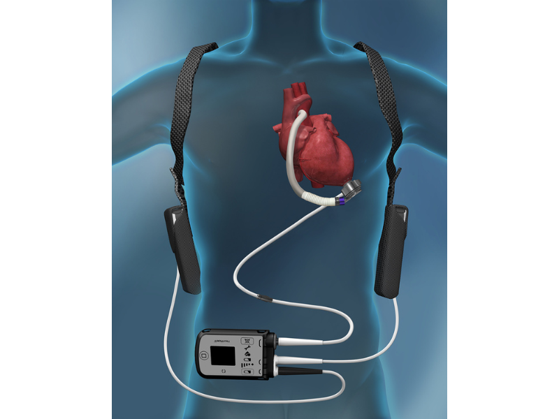 The Abbott HeartMate 3 LVAD device